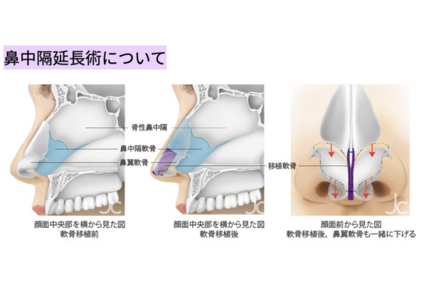 鼻中隔延長手術の詳細写真